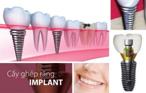 Cấy ghép răng implant giá bao nhiêu? 1