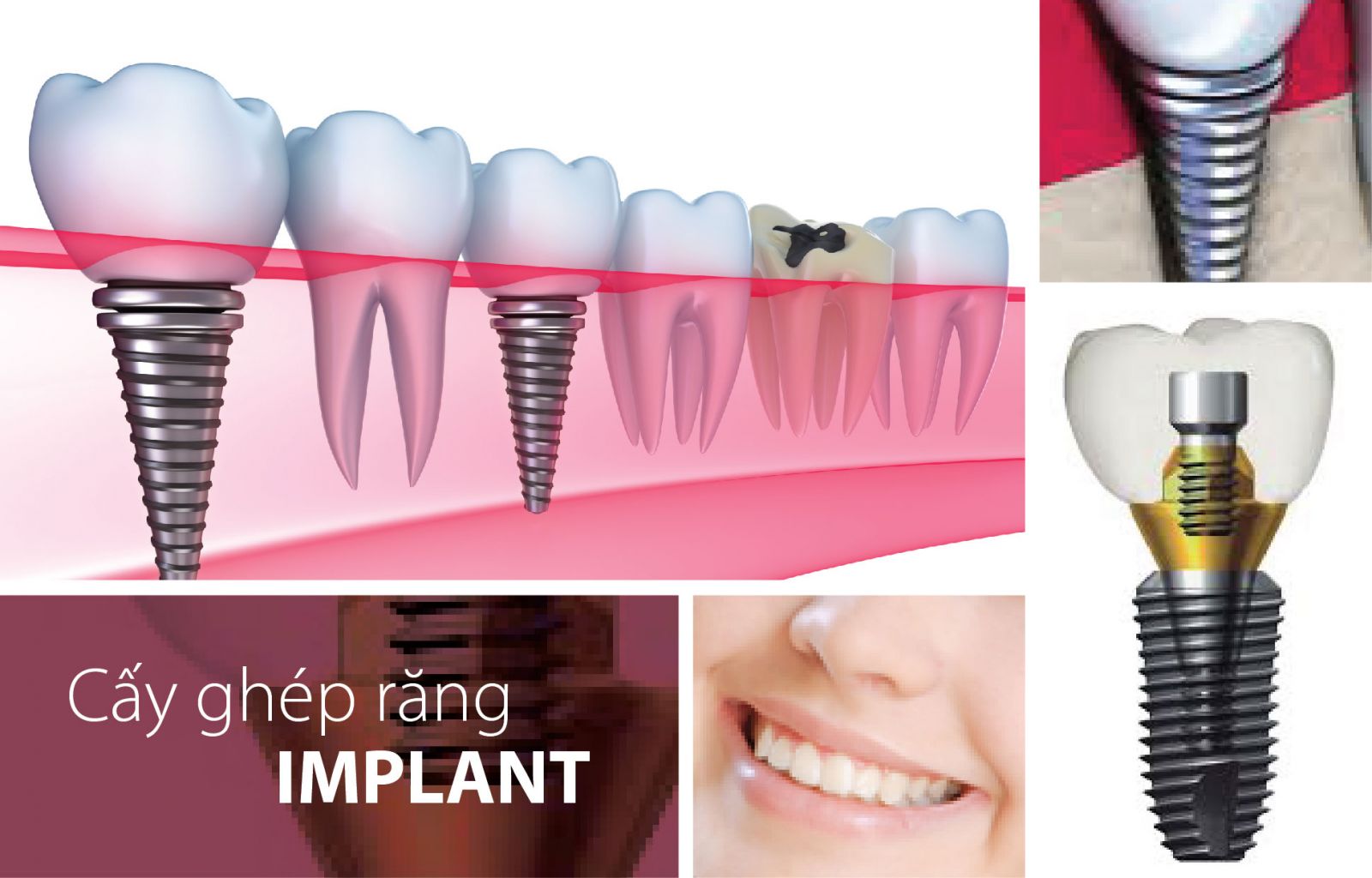 Trồng răng implant giá bao nhiêu ?