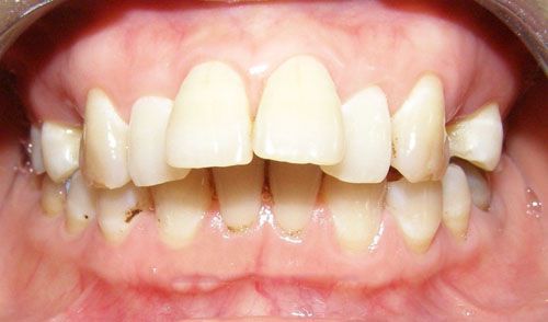 Niềng răng chỉnh hô có đau không?