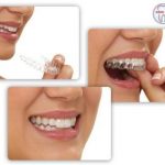 Tiết lộ phương pháp niềng răng bằng nhựa cực hiệu quả thẩm mỹ cao