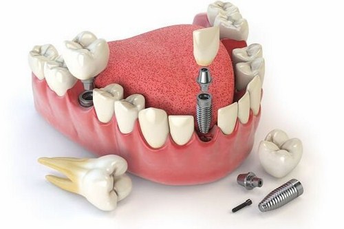 Cắm implant răng cửa khi nào? 2