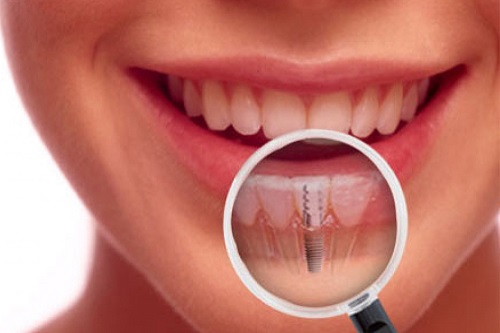 Trồng răng implant có đau không? Cần lưu ý gì  3