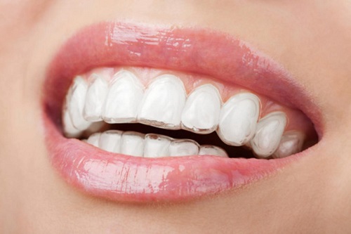 Công nghệ chỉnh nha mới - Niềng răng không mắc cài 3d clear aligner 3