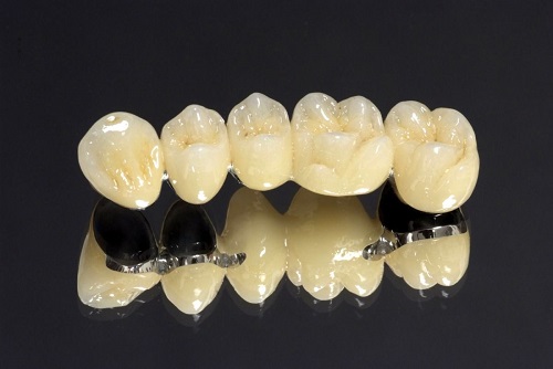 Răng sứ bị đen viền nướu nguyên nhân chính do đâu? 1