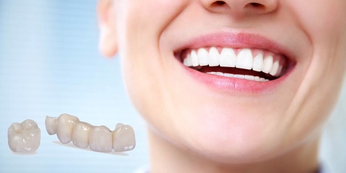 Răng sứ bị đen viền nướu nguyên nhân chính do đâu? 4