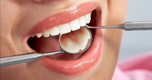 Giải pháp khắc phục răng thưa - Bọc răng cửa bị thưa 3