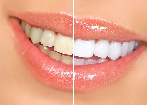 Kết quả bọc răng sứ giữ được bao lâu vậy? 4