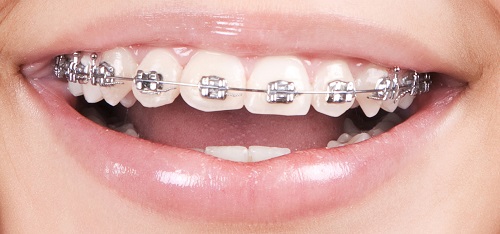 Trong quá trình niềng răng giai đoạn nào đau nhất? 3