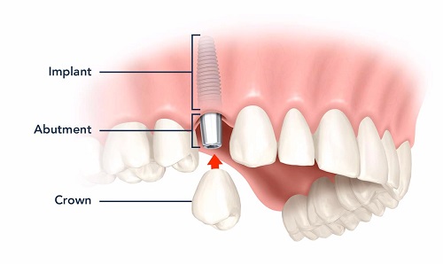 Kỹ thuật trồng răng sứ an toàn hiệu quả cao 2