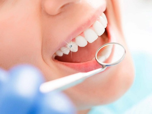 Bọc răng sứ có đính đá được không bác sĩ? 2