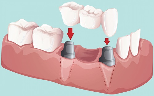 Trồng răng sứ có ảnh hưởng gì không? Giải đáp từ chuyên gia 1