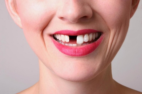 Trồng răng sứ có bền không? Thực hư thế nào 1