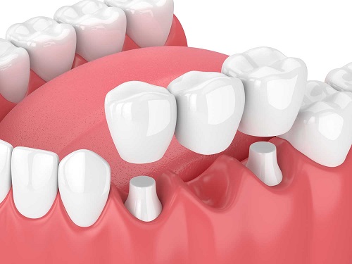 Trồng răng sứ có lâu không? Quy trình thực hiện 2