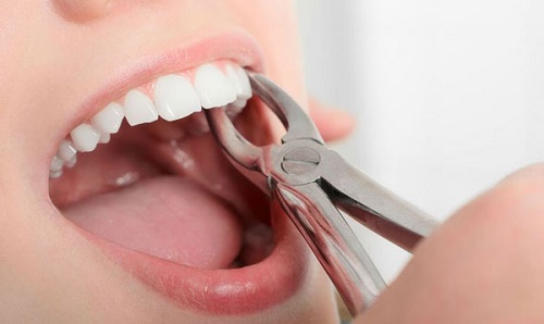 Nhổ răng hàm không đau có thật không? Nhờ nha khoa tư vấn 2