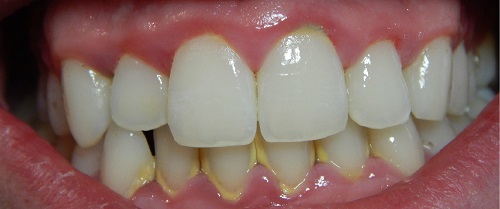 Lấy cao răng có đau không? Cách thực hiện lấy cao răng 1