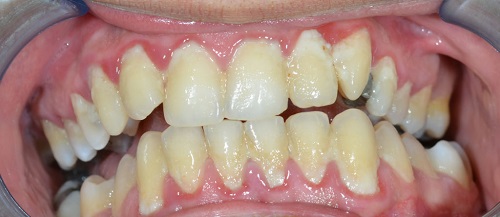 Lấy cao răng có đau không? Cách thực hiện lấy cao răng 2