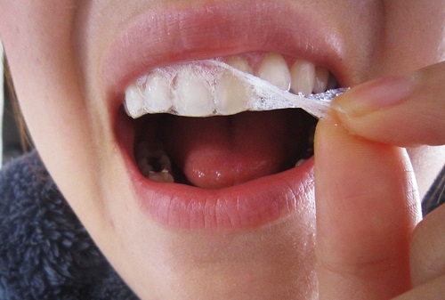 Có nên dùng miếng dán tẩy trắng răng không? 1