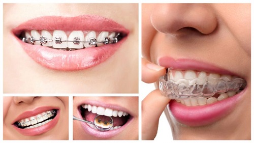 Niềng răng chỉnh hàm lệch có được không? 3