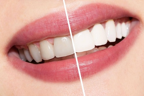 Tẩy trắng răng có ảnh hưởng gì không? Tìm hiểu ngay 1