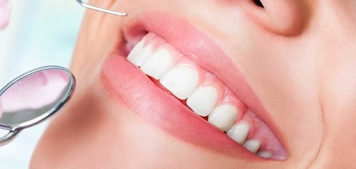 Tẩy trắng răng có ảnh hưởng gì không? Tìm hiểu ngay 3