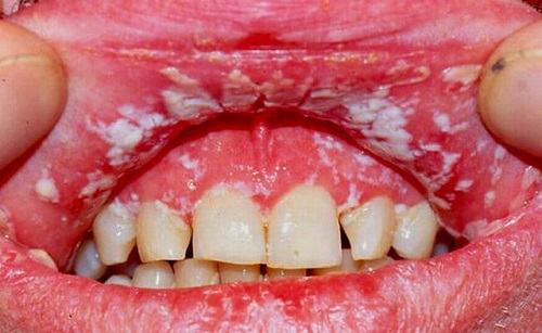 Tác hại của việc tẩy trắng răng bạn nên biết 2