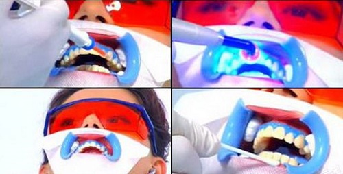 Tẩy trắng răng plasma có hại không? Tìm hiểu chi tiết 2
