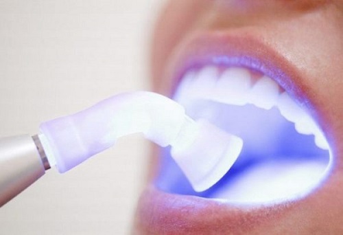 Tẩy trắng răng xong có được đánh răng không? Lưu ý cho bạn 1