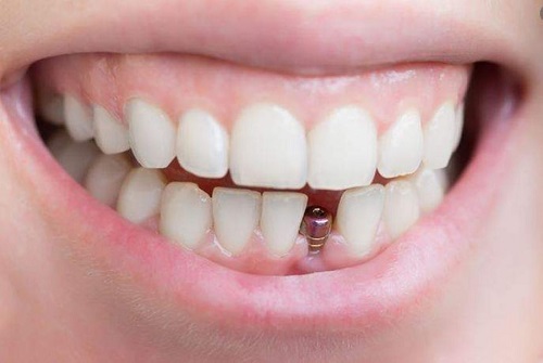 Trồng răng cửa hàm dưới cần lưu ý gì? 1