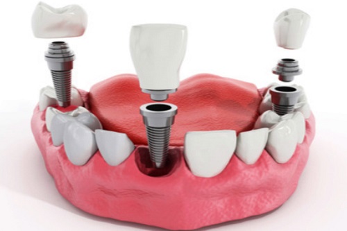 Trồng răng có chân răng - Giải pháp tối ưu cho bạn 3