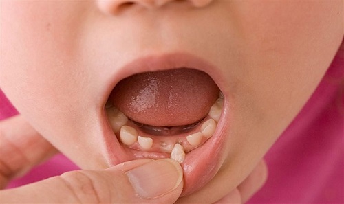 Nhổ răng sữa cho trẻ em - Những lưu ý cần biết 2