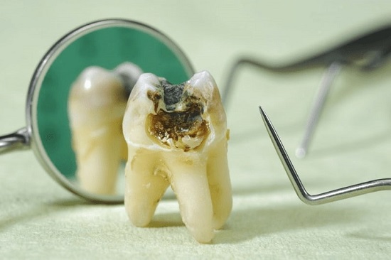 Răng khôn hàm trên bị sâu nên nhổ hay không? 3
